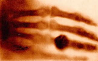 Röntgenkuva kädestä